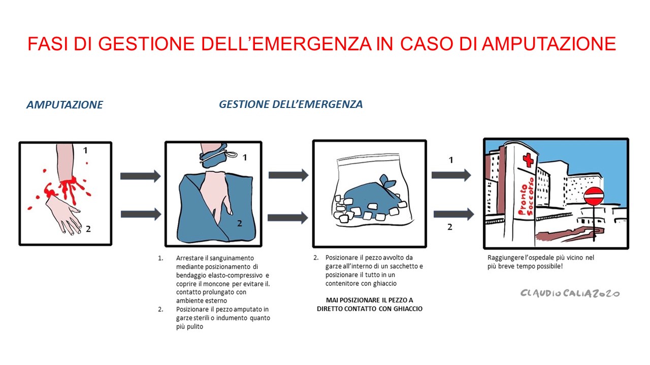 Immagine: FASI DI GESTIONE DELL'EMERGENZA IN CASO DI AMPUTAZIONE = disegni amputazione mano = autore Claudio Calia 2020 || Cfr. «In tempi record, chirurghi dellfOspedale di Padova reimpiantano la mano destra di un 64enne recisa a livello distale dellfavambraccio; lfeccezionale intervento è riuscito.» = [17 Giugno 2020 - Azienda Ospedaliera di Padova - aopd.veneto.it]